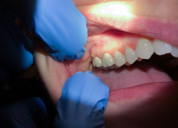 Best Broken or Cracked Tooth Emergency Dentist in Eaton, CO